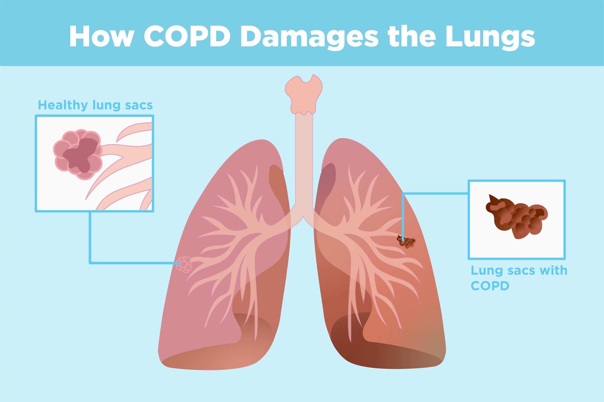 علائم بیماری انسداد ریه COPD